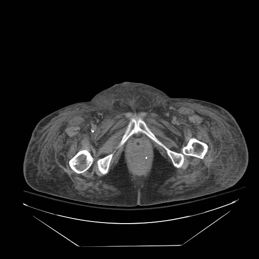 Abdominal aortic aneurysm - impending rupture (Radiopaedia 19233-19247 Axial non-contrast 172).jpg