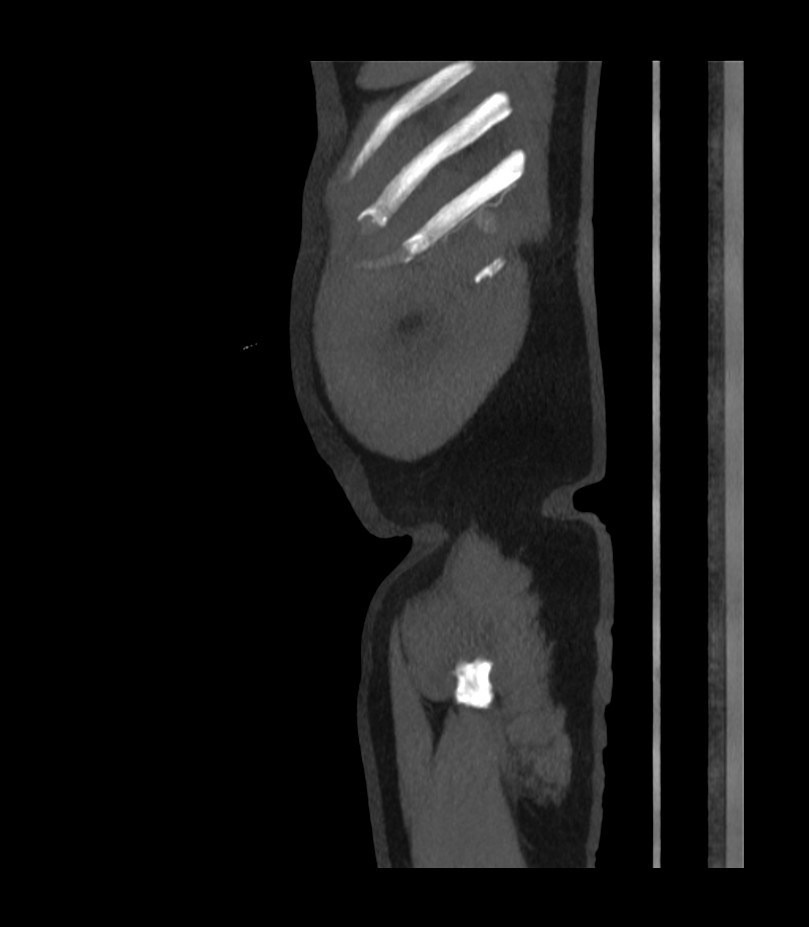 Abdominal aortic aneurysm with thrombus fissuration (Radiopaedia 46218-50618 Sagittal C+ arterial phase 58).jpg