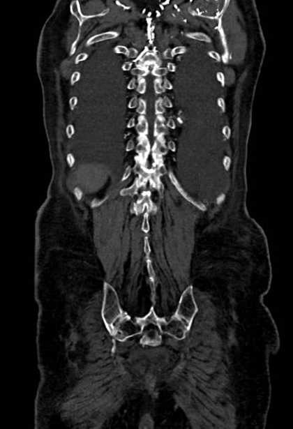 Abdominal aortic aneurysm with thrombus fissuration (Radiopaedia 73192-83919 Coronal C+ arterial phase 80).jpg