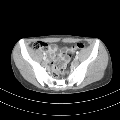 File:Abdominal multi-trauma - devascularised kidney and liver, spleen and pancreatic lacerations (Radiopaedia 34984-36486 Axial C+ portal venous phase 66).png