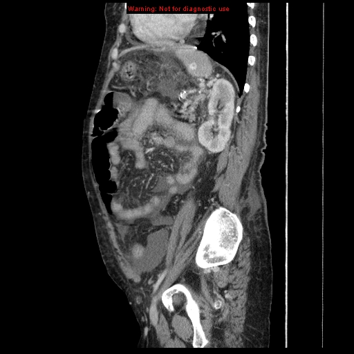 Abdominal wall hematoma (Radiopaedia 9427-10112 Sagittal C+ portal venous phase 33).jpg