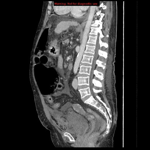 Abdominal wall hematoma (Radiopaedia 9427-10112 Sagittal C+ portal venous phase 50).jpg
