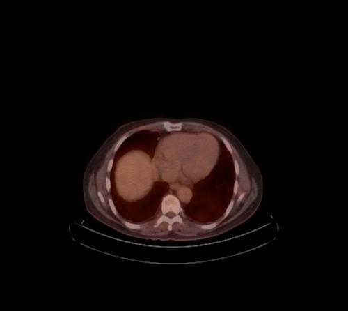File:Abdominal wall metastasis from colorectal carcinoma (Radiopaedia 31016-31719 C 97).jpg
