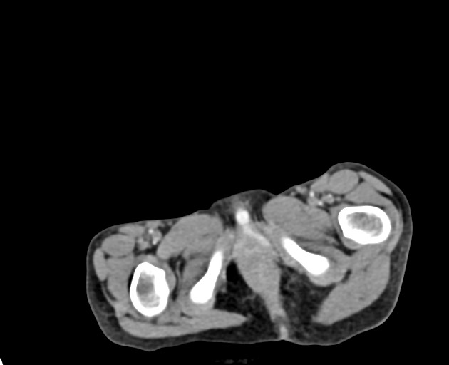Abdominopelvic rhabdomyosarcoma (Radiopaedia 78356-90984 Axial C+ portal venous phase 161).jpg