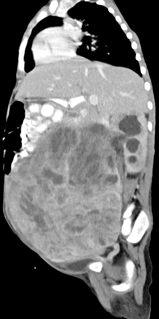 Abdominopelvic rhabdomyosarcoma (Radiopaedia 78356-90984 Sagittal C+ portal venous phase 58).jpg