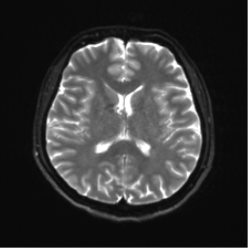 Abducens nerve palsy (Radiopaedia 51069-56648 Axial DWI 15).png