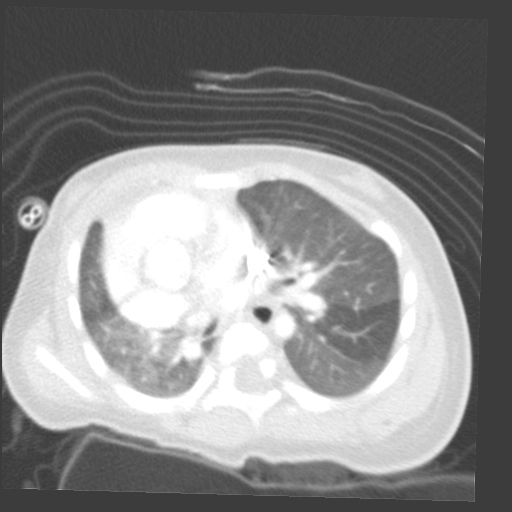 File:Aberrant left pulmonary artery (pulmonary sling) (Radiopaedia 42323-45435 Axial lung window 18).jpg