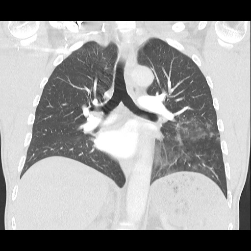 Accessory left horizontal fissure with lingular pneumonia (Radiopaedia 53763-59843 Coronal lung window 26).jpg
