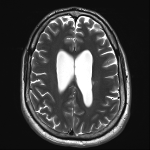 File:Achondroplasia (Radiopaedia 65109-74105 Axial T2 27).png