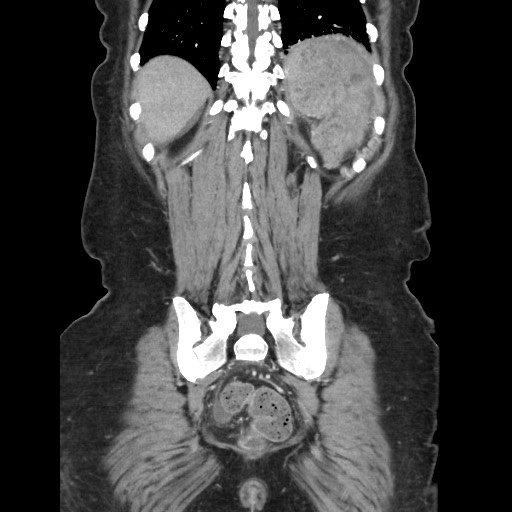 Acinar cell carcinoma of the pancreas (Radiopaedia 75442-86669 Coronal C+ portal venous phase 104).jpg