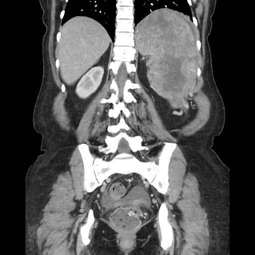 Acinar cell carcinoma of the pancreas (Radiopaedia 75442-86669 Coronal C+ portal venous phase 93).jpg