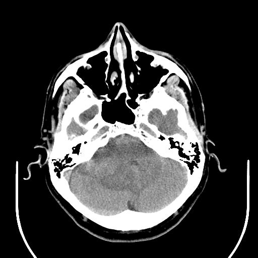 File:Acoustic schwannoma (Radiopaedia 29488-29982 AXIAL THICK non-contrast 12).jpg