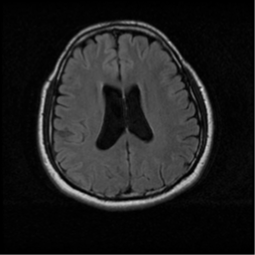 File:Acoustic schwannoma (Radiopaedia 33045-34060 Axial FLAIR 14).png