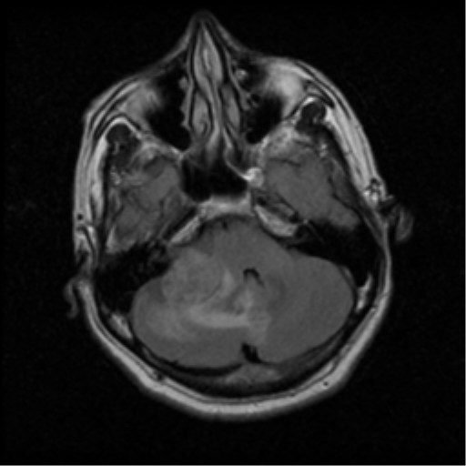 File:Acoustic schwannoma (Radiopaedia 39170-41387 Axial FLAIR 5).png