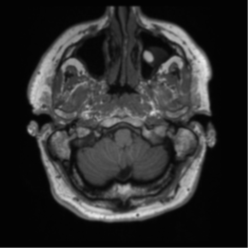 File:Acoustic schwannoma (Radiopaedia 50846-56358 Axial T1 1).png