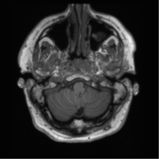 File:Acoustic schwannoma (Radiopaedia 50846-56358 Axial T1 3).png