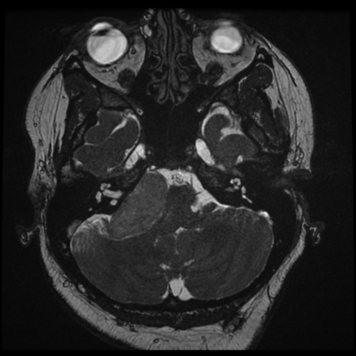 Acoustic schwannoma (Radiopaedia 57574-64536 Axial T2 24).png