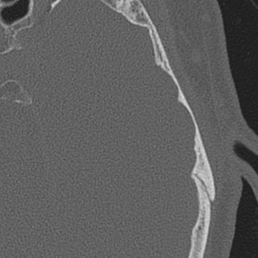 Acoustic schwannoma - cystic (Radiopaedia 29487-29980 AXIAL LEFT bone window 54).jpg
