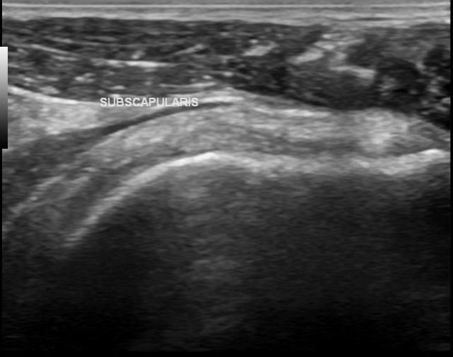 File:Acromial fracture - ultrasound (Radiopaedia 26729-26891 D 1).jpg