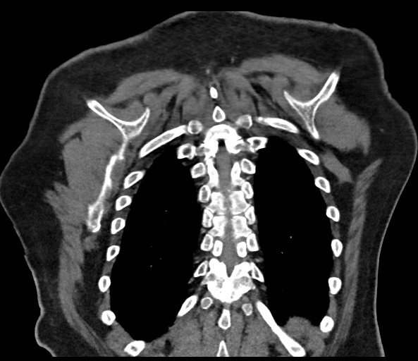 File:Acromioclavicular joint cyst (Radiopaedia 58455-65610 Coronal C+ arterial phase 119).jpg