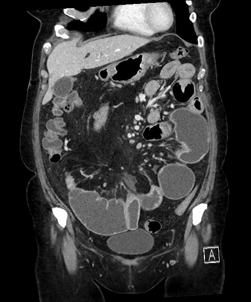 Active Crohn disease (Radiopaedia 59394-66750 Coronal C+ portal venous phase 26).jpg