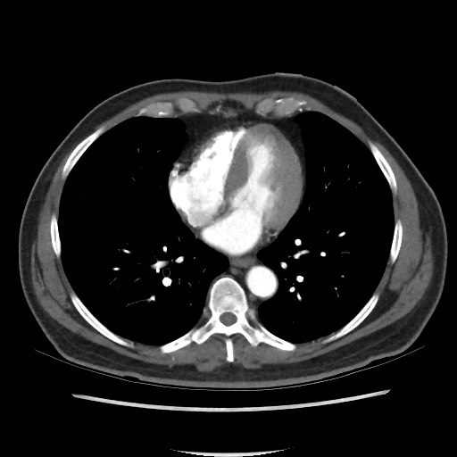 Active colonic bleed on CT (Radiopaedia 49765-55025 Axial C+ arterial phase 1).jpg