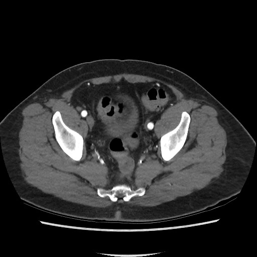 Active colonic bleed on CT (Radiopaedia 49765-55025 Axial C+ arterial phase 71).jpg