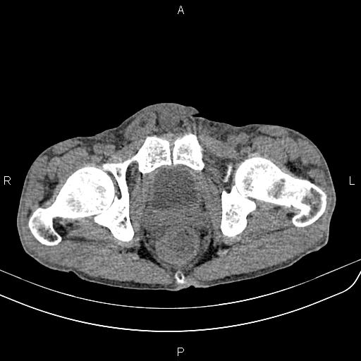 Active crohn disease (Radiopaedia 87133-103397 Axial non-contrast 101).jpg