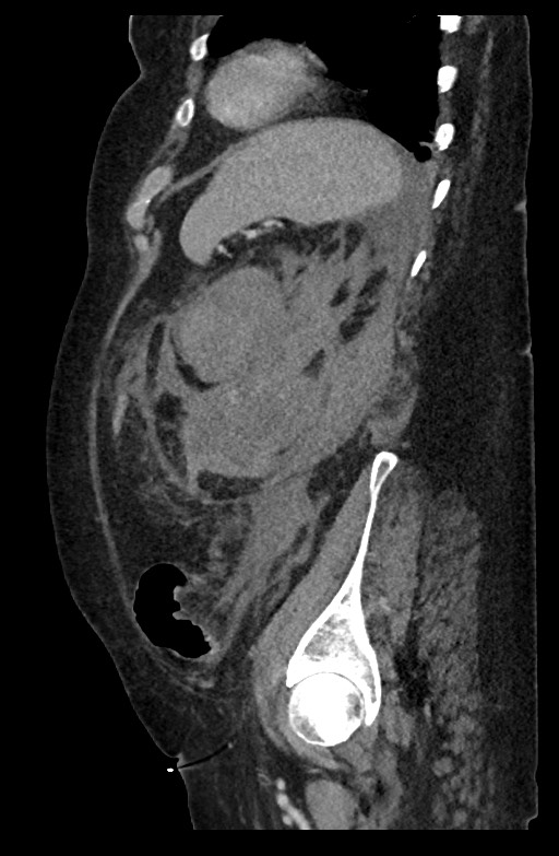 Active renal extravasation with large subcapsular and retroperitoneal hemorrhage (Radiopaedia 60975-68796 Sagittal C+ portal venous phase 69).jpg