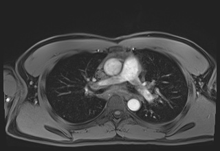 File:Active right ventricular cardiac sarcoidosis (Radiopaedia 55596-62100 Axial Post contrast Dixon 25).jpg