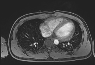 File:Active right ventricular cardiac sarcoidosis (Radiopaedia 55596-62100 Axial Post contrast Dixon 51).jpg