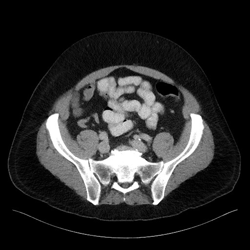Acute-on-chronic pancreatitis (Radiopaedia 67286-76656 Axial C+ portal venous phase 60).jpg