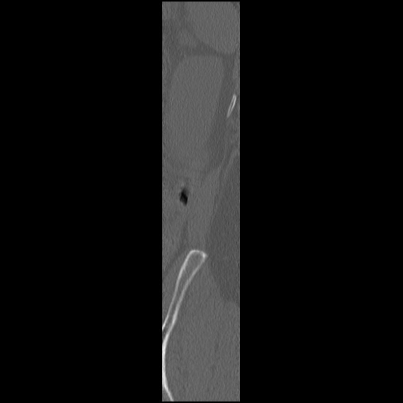 Acute Schmorl's node (Radiopaedia 83276-102365 Sagittal bone window 2).jpg