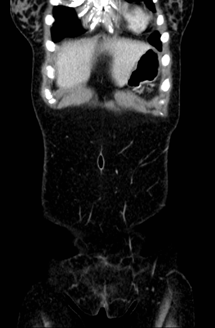 Acute appendicitis (Radiopaedia 22892-22918 Coronal C+ portal venous phase 3).png