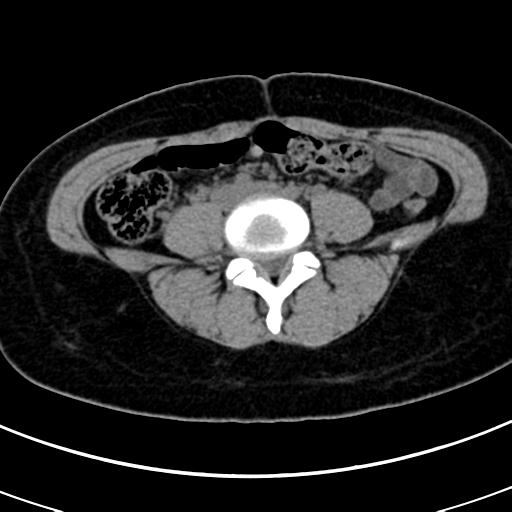 Acute appendicitis (Radiopaedia 30261-30888 Axial non-contrast 55).jpg