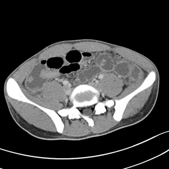 Acute appendicitis (Radiopaedia 32614-33572 Axial C+ portal venous phase 46).jpg