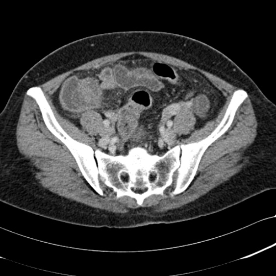 File:Acute appendicitis (Radiopaedia 48792-53822 Axial C+ portal venous phase 88).jpg