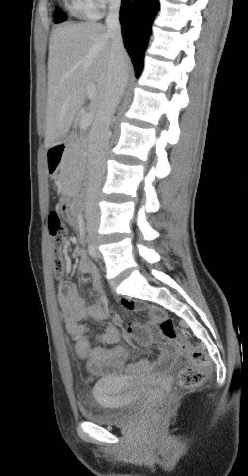 Acute appendicitis (Radiopaedia 62608-70901 Sagittal C+ portal venous phase 23).jpg