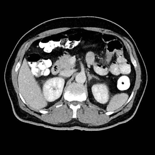 Acute appendicitis (Radiopaedia 77016-88960 Axial C+ portal venous phase 50).jpg