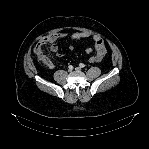 Acute appendicitis (Radiopaedia 79950-93224 Axial C+ portal venous phase 71).jpg