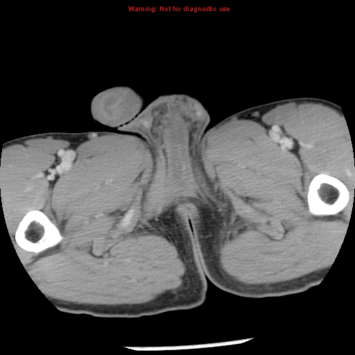 Acute appendicitis (Radiopaedia 8195-9045 Axial C+ portal venous phase 86).jpg