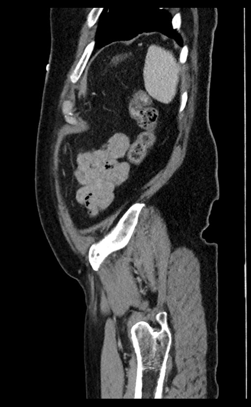Acute appendicitis - large appendicoliths (Radiopaedia 61805-69820 Sagittal C+ portal venous phase 14).jpg