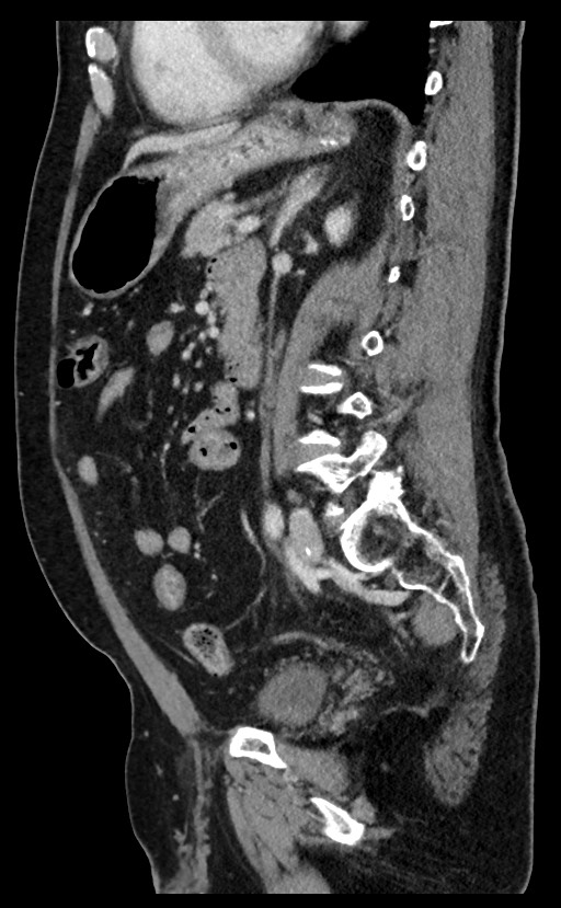 Acute appendicitis - large appendicoliths (Radiopaedia 61805-69820 Sagittal C+ portal venous phase 47).jpg