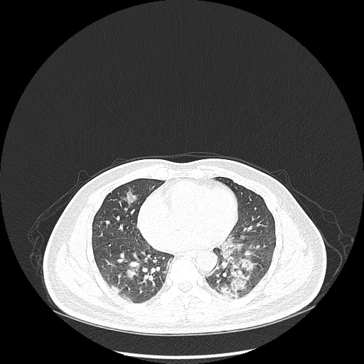 Acute appendicitis and COVID 19 pneumonia (Radiopaedia 76604-88380 Axial lung window 34).jpg