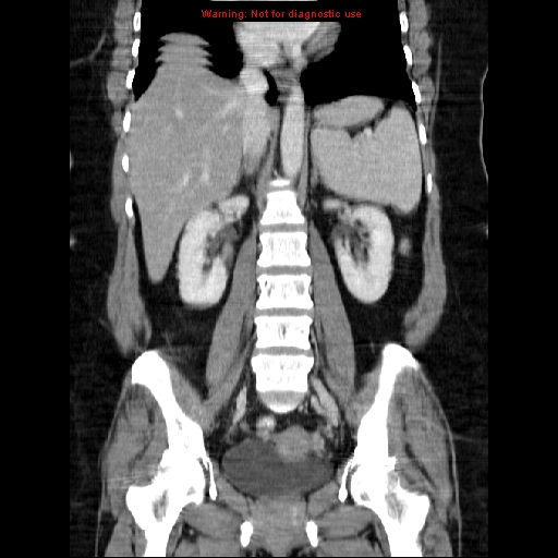 File:Acute appendicitis complicated by ovarian vein thrombophlebitis (Radiopaedia 16172-15851 Coronal C+ portal venous phase 50).jpg