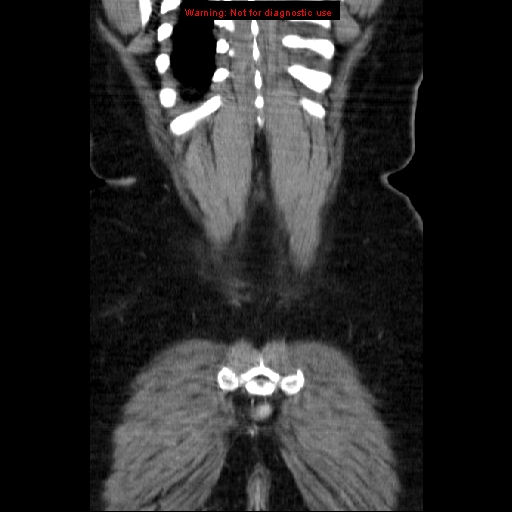 File:Acute appendicitis complicated by ovarian vein thrombophlebitis (Radiopaedia 16172-15851 Coronal C+ portal venous phase 75).jpg