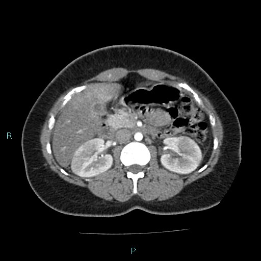 Acute bilateral pyelonephritis (Radiopaedia 37146-38881 Axial C+ arterial phase 76).jpg