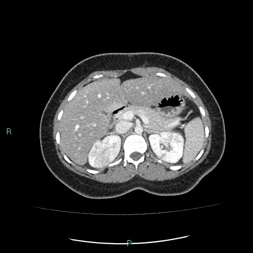 Acute bilateral pyelonephritis (Radiopaedia 37146-38881 Axial C+ portal venous phase 32).jpg