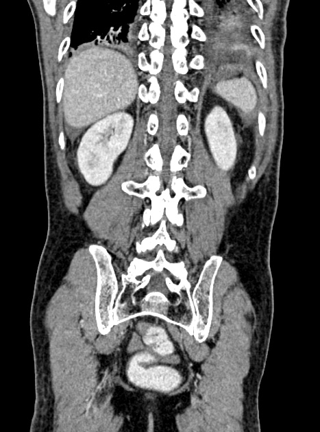 Acute bowel ischemia (Radiopaedia 87695-104114 Coronal C+ portal venous phase 298).jpg