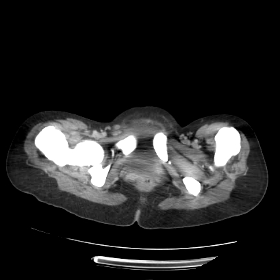 Acute calculous cholecystitis in patient with osteopetrosis (Radiopaedia 77871-90159 Axial C+ portal venous phase 80).jpg